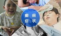  青少年癫痫发作影响发育吗