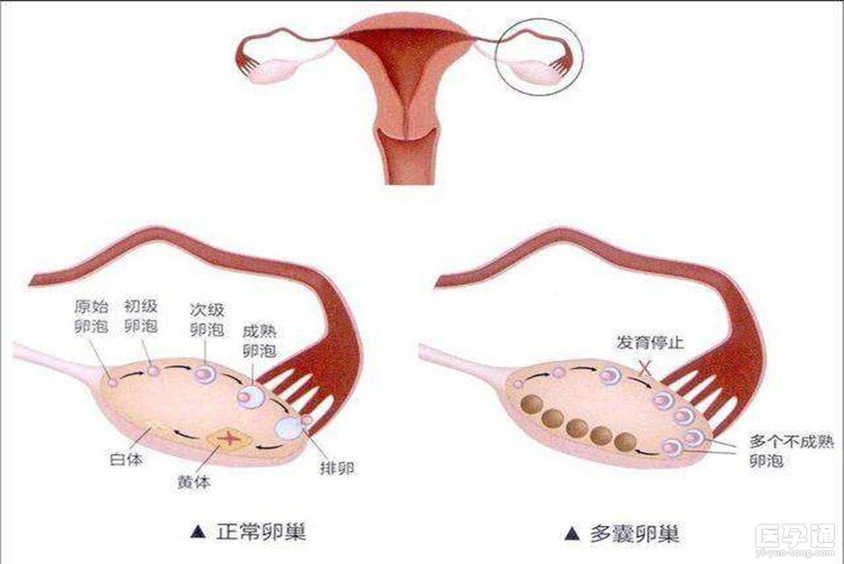 多囊患者如何调理？