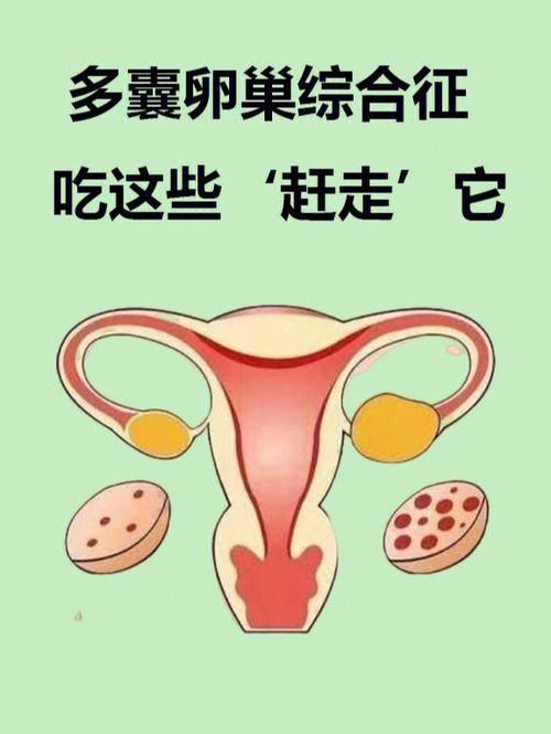 多囊卵巢综合征吃什么药最佳
