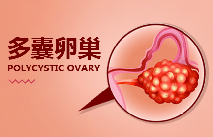 多囊卵巢综合征能治愈吗？