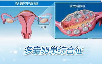 多囊卵巢都有哪些危害