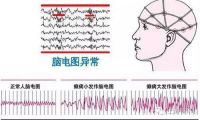 癫痫病发作会不会到导致后遗症