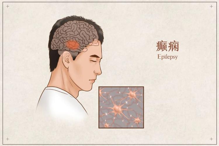 癫痫病大发作时吸入异物怎么办