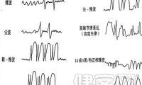 脑电图棘波,棘慢波发放是什么意思